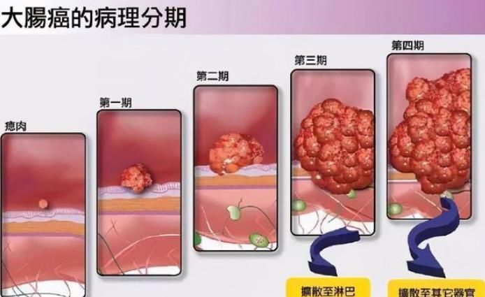 35岁男子患癌离世，医生：上完厕所多看一眼，关键时刻能保命!