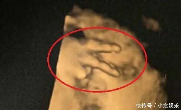 彩超|迫不及待想看孩子,四维彩超时宝宝却比个“v”,医生忍不住笑了
