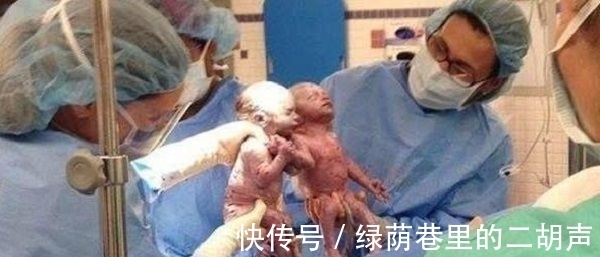 女婴|双胞胎手牵手一起出生,罕见的一幕,在场的医护人员都被暖化了