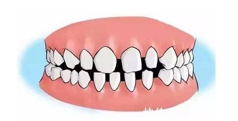 干预|儿童做牙齿矫正三个最佳时间家长要牢记,矫治越早干预效果越好