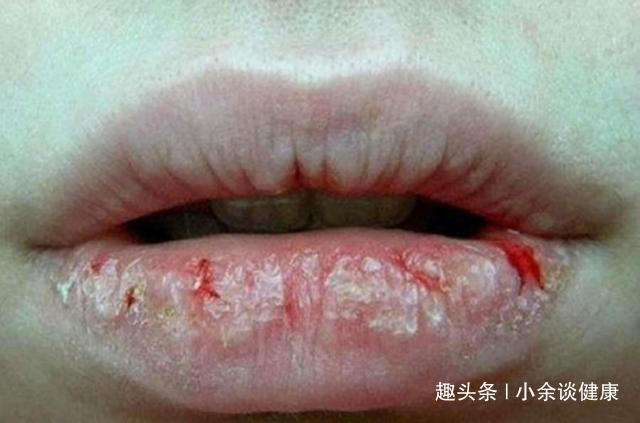 脱发|失眠是缺镁，脱发是缺锌，身体缺乏“营养素”的6种表现，你有吗