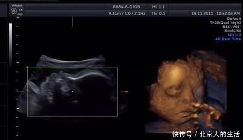 21三体综合症|孕检结果正常,却生出畸形宝宝,怀孕多少周做排畸检查准确率最高