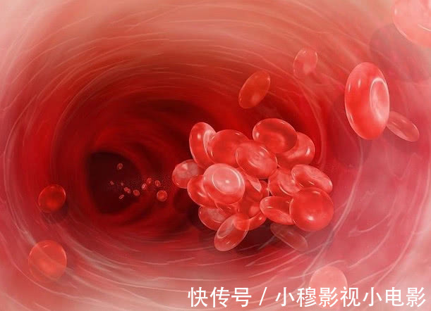 血管|“脑梗”死亡上百万，这3种食物要拒绝，贪吃加速血管“堵死”