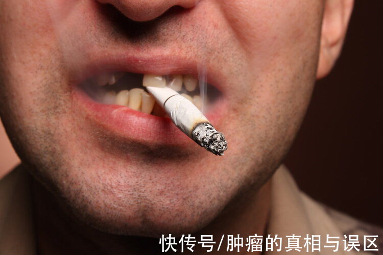 大蒜|针对中国人的研究：吸烟可增加胃癌死亡率，大蒜或起到预防作用
