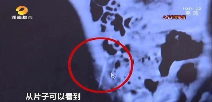 牙签|两岁女童玩耍,牙签意外插入腹腔!医生提醒:异物扎入体内勿自行拔出!