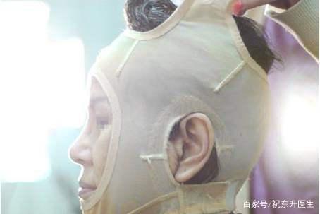 缝线 求美者说52岁,做完拉皮手术后的90天