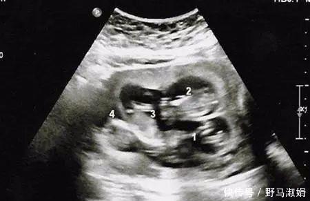 医生|25岁孕妈12周肚大如“临盆”，检查后丈夫愁坏了，医生却笑了