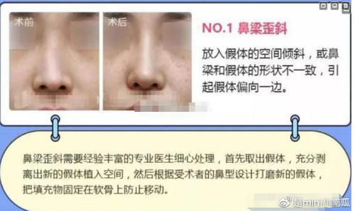 鼻小柱 隆鼻失败症状＆隆鼻失败修复时间＆手术方法解析