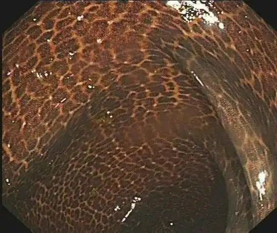 酵素|可怕！阿姨为治便秘吃3年酵素，大肠表面宛若蛇皮......