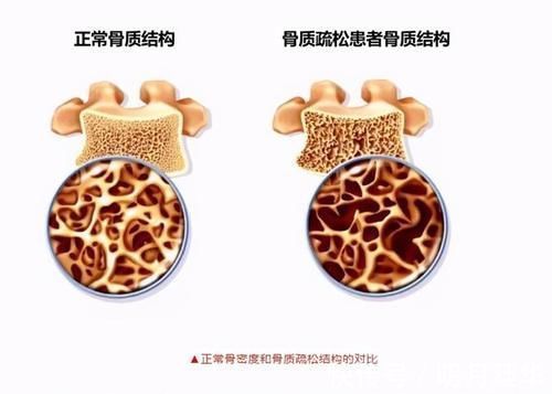 女性朋友|女人过了50岁,这2种食物要舍得吃,或能帮你预防骨质疏松