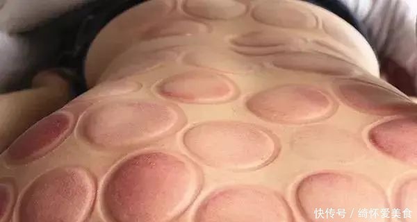 湿气|拔火罐到底吸出来是湿气,还是毒素?答案或和你想的不同
