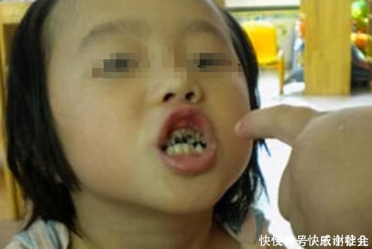 蛀牙|3岁孩子满口蛀牙,妈妈却毫不在意说等换牙就好,医生怒斥无知