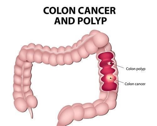 常见病|医生提醒5种常见病，其实是癌前病变很少人愿意去医院治