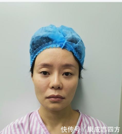 求美者|小拉皮术后1个月,总结几点我的体验感受