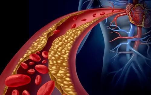 食物|血脂偏高的人,不能吃面食吗?提醒:建议养成这三个好习惯
