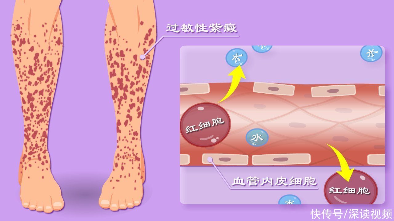 通透性|从腿上小红疹到血尿、蛋白尿，过敏性紫癜是咋搞出肾损伤的？
