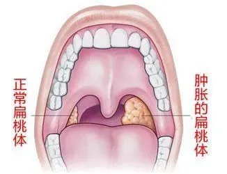 扁桃体周围炎|咽口水都痛，晚上睡不好…咽喉痛，不容忽视
