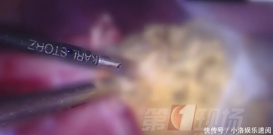 吃头发|头皮发麻14岁女孩胃里竟塞满…这个可怕习惯她保持了十年