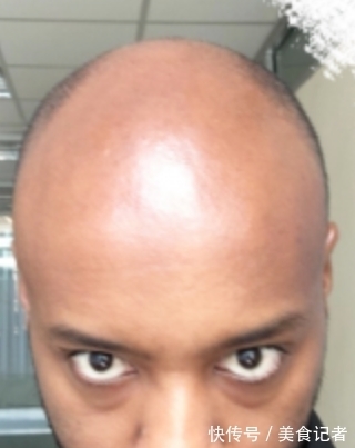 chris 每个月到底有多少人去土耳其植发？