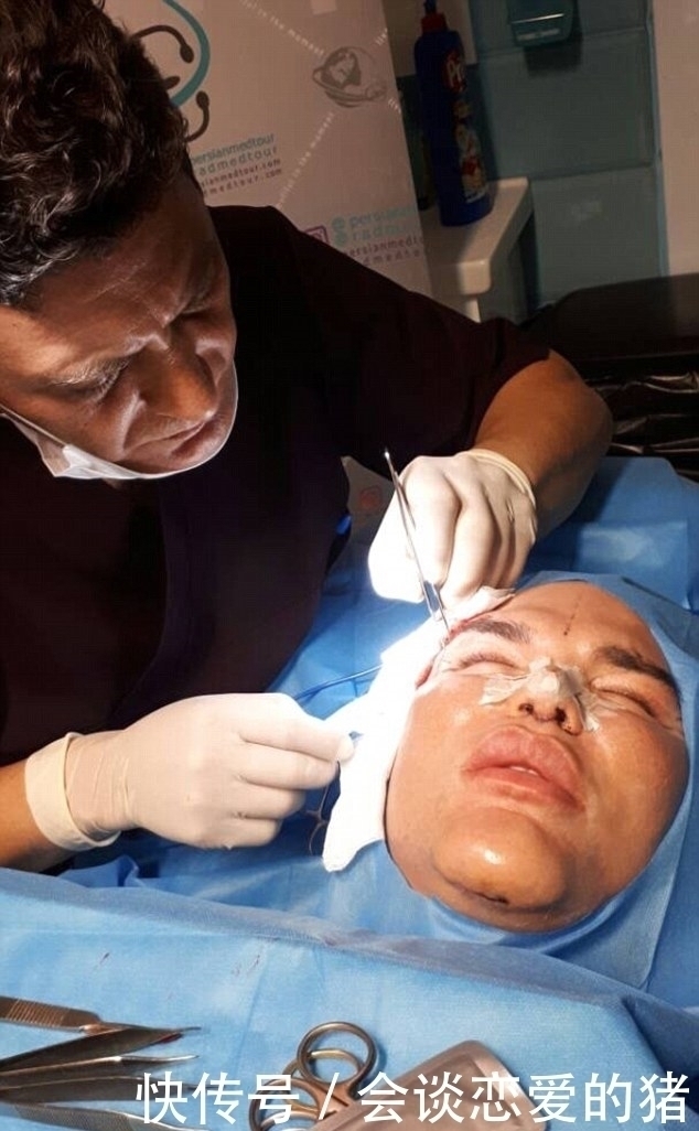 隆鼻|33岁男子整容上瘾,花了百万巨资整容62次,鼻子被整得无法呼吸