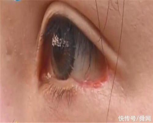 小到 女子整容失败遭破相,术后下眼睑少了一块,就像是腐烂的蚌壳肉……