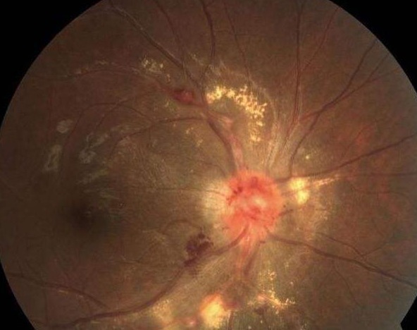 食物|加速高血压的3种食物，若你一个都不爱吃，那恭喜了