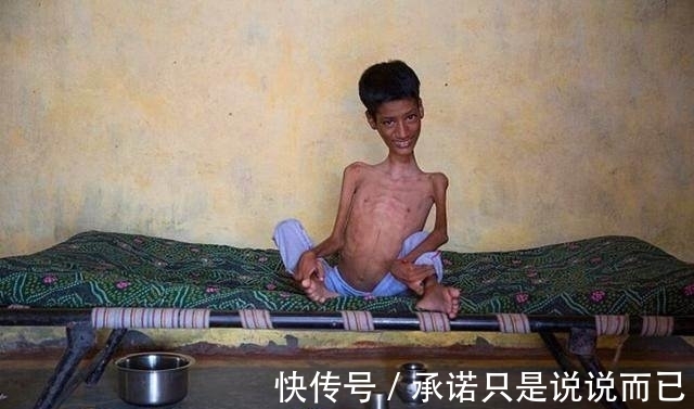 利瓦|男孩头部怪异,只能挂在胸前,手术7个月后的模样让人感动到哭!