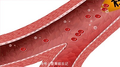 脑梗死|为什么脑梗死容易复发，有什么办法可以预防？医生为您讲清楚