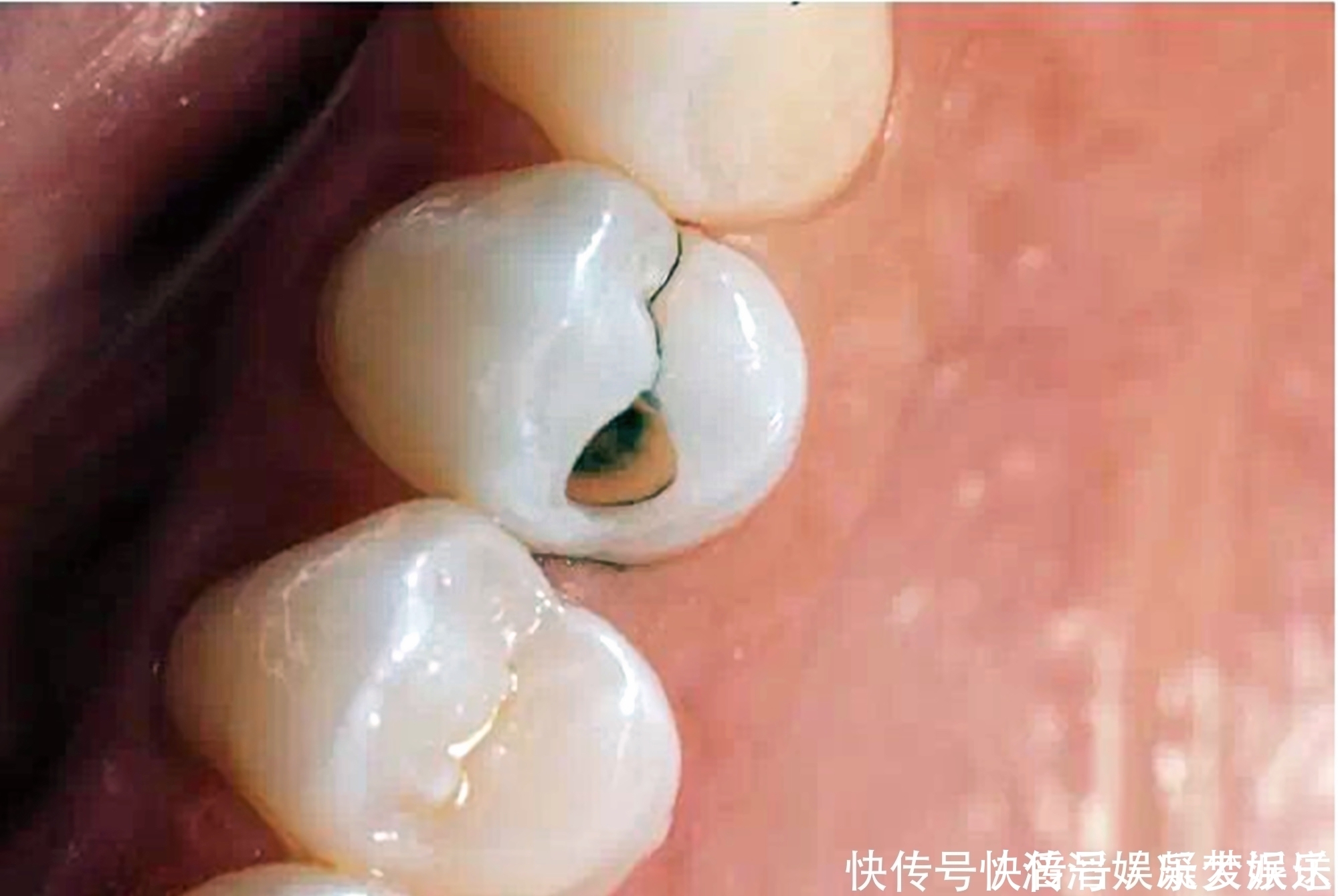 恒牙|好不容易等到宝宝换牙期,新牙却长歪了医生家长无知惹得锅