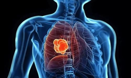 胡萝卜素|医生:肺部有结节的人,“3种”食物建议少吃,或有助结节消散