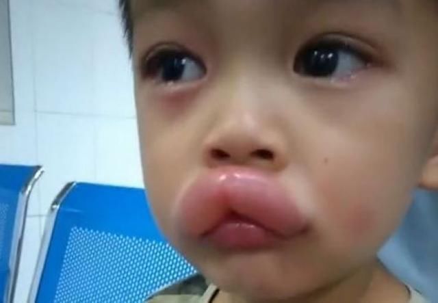 葡萄|熊孩子偷吃了一颗葡萄,嘴巴变成了香肠嘴,医生看了都憋笑