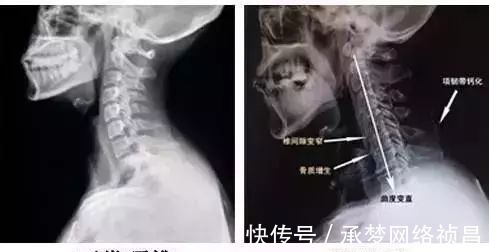 膏药|不花钱也能治颈椎病,无花果+红糖+蜂蜜,再顽固也能用!