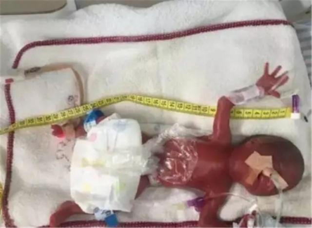 孕妇|还记得世界上“最小婴儿”吗?网友都期待她长大模样,如今她来了