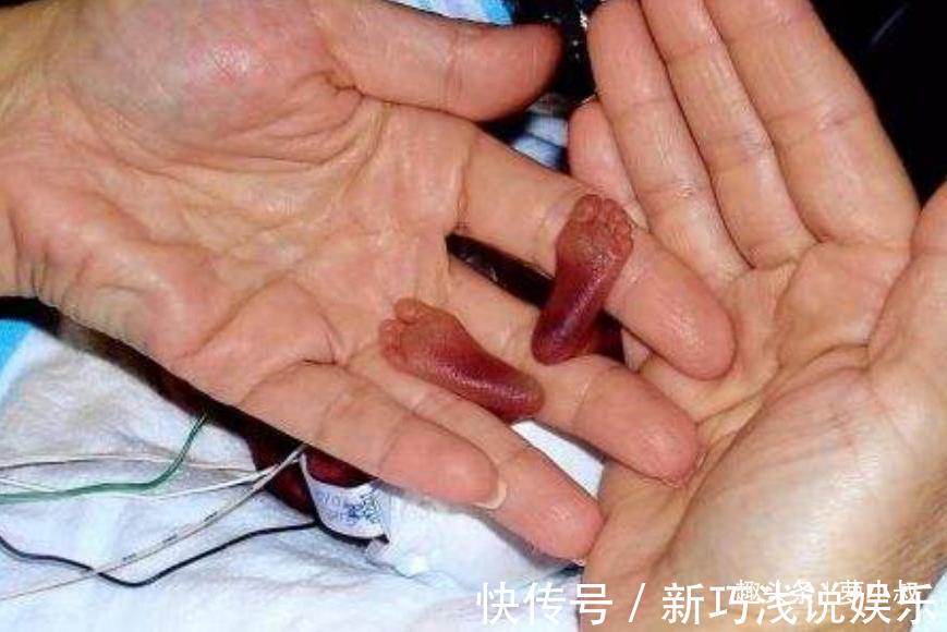 宝宝|14年前那个世上最小婴儿,看到如今颜值后,真令人羡慕!