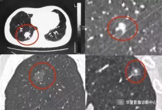 患者|从肺结节到肺癌，10个月影像记录，提醒我们正确对待肺结节处理