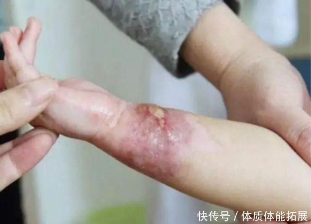 安全意识|孩子烫伤后最佳救治时间只有90秒,第一步该做啥很多家长都做错!