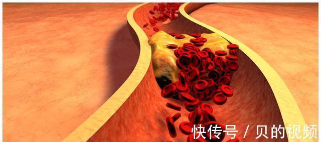 血管|血脂超标要少喝粥？这3种食物或有利于血管健康，不妨常吃点