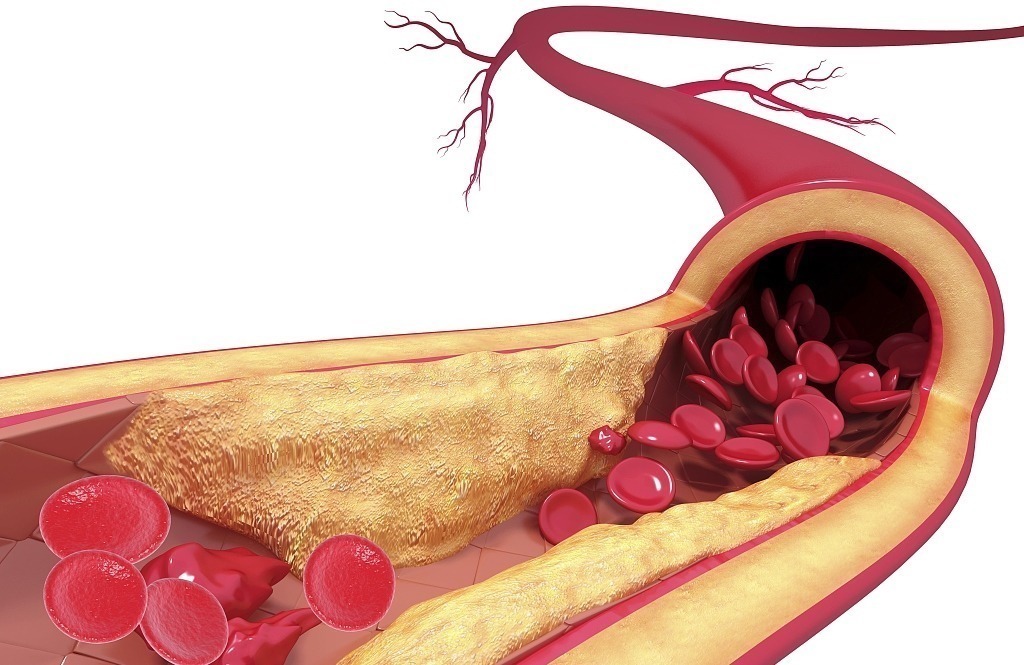 血脂|高血脂的人能一天吃一个鸡蛋吗平时坚持3件事,可有效降低血脂