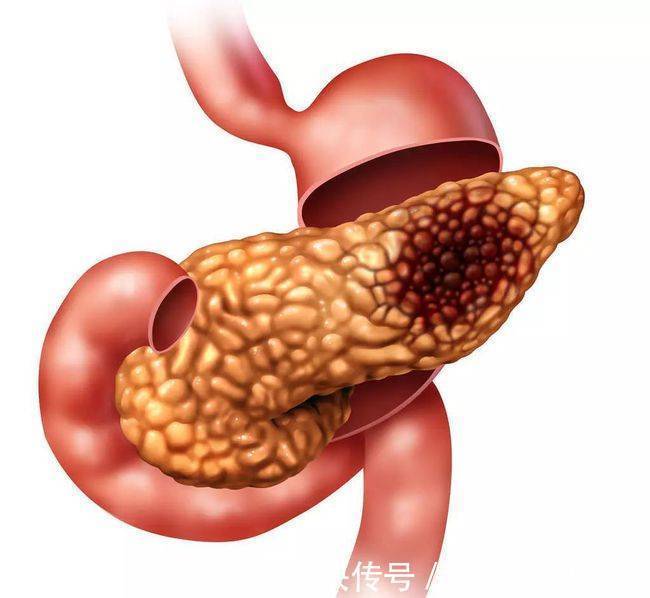 十二指肠|北京古楼疑难病研究院于加军:胰腺癌会有哪些症状表现?