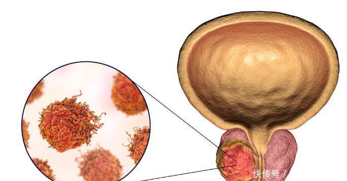 治疗|哪些不良习惯会导致前列腺癌？如何检查及治疗？医生告诉您