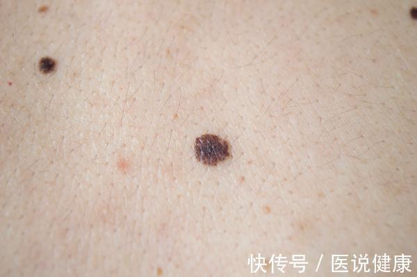 色素痣|皮肤上出现了红痣,还伴随这4种情况,当心是皮肤肿瘤找上门了