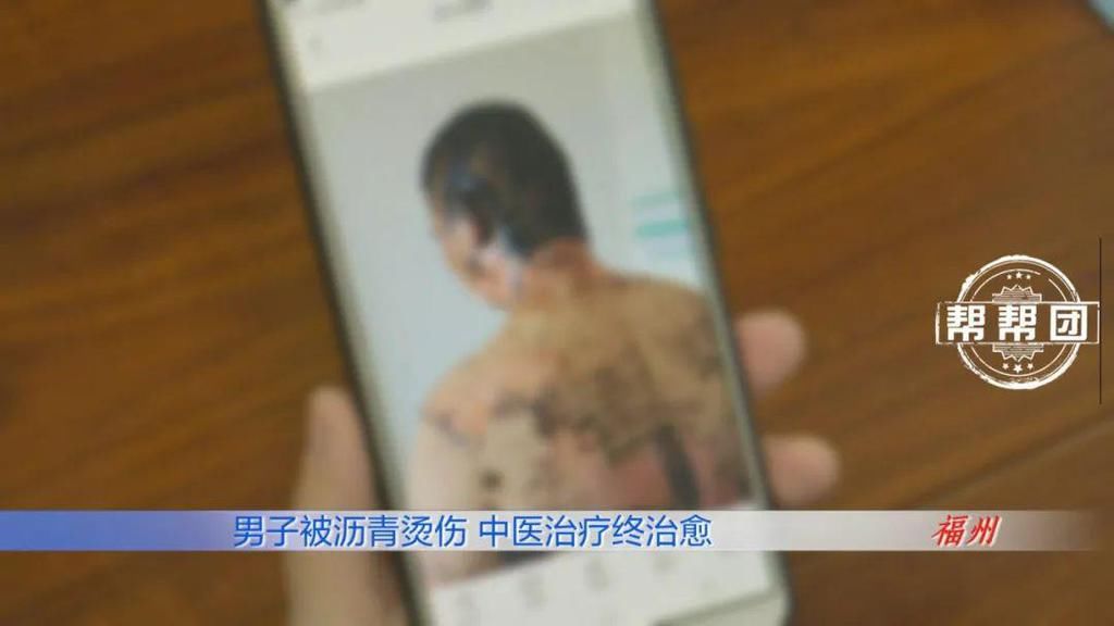  全身|惊心！滚烫的沥青从头浇下，男子全身多处遭遇严重烧烫伤