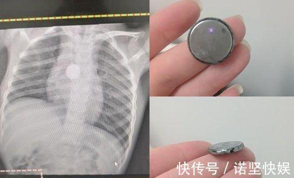 5岁女儿暴瘦,检查时医生让“摘下项链”,妈妈我女儿没带项链