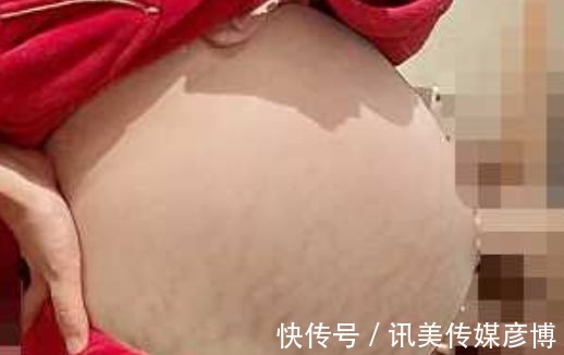 孕纹|长了妊娠纹就没救了?别交智商税,做好这些事,和妊娠纹说拜拜