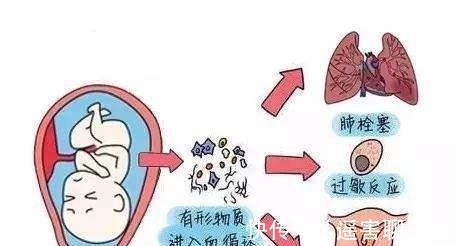 羊水|分娩后或分娩过程中，为什么医生担心产妇出现咳嗽？