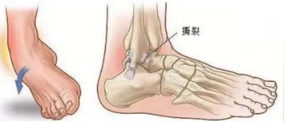 崴脚了应该怎么处理？做错了后果很严重！