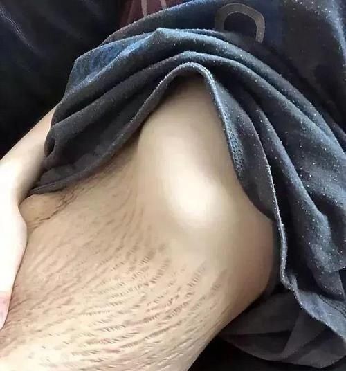 润肤|四胞胎妈妈身材“太好”走红网络,她掀起衣服后,网友都捂住了嘴