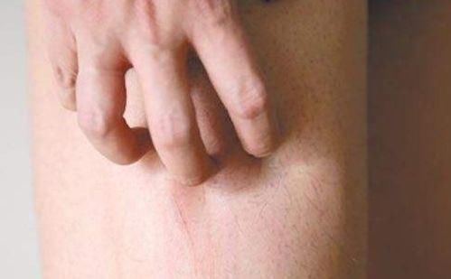 肝硬化|45男子以为皮肤过敏，却查出肝硬化，医生：身体2处发痒尽早检查