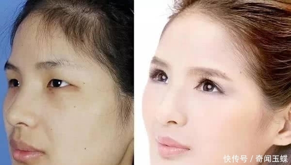 双眼皮|实拍:10张女孩整容前后的对比照,这真就是换了一张脸