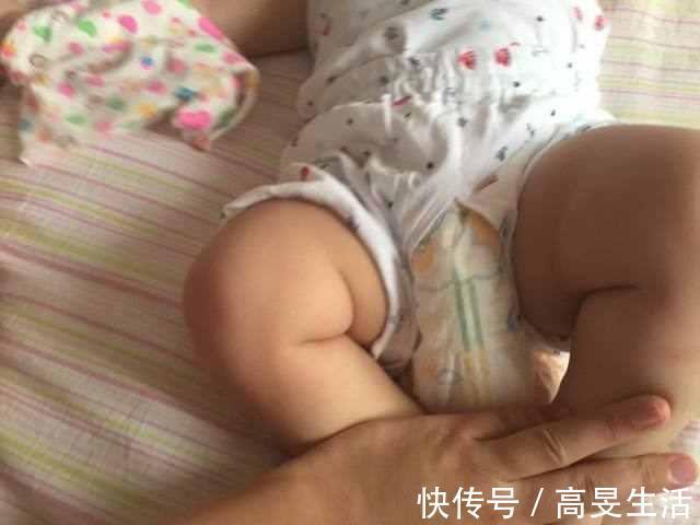 腿纹|8个月宝宝的腿纹不一致,一家人发现的太晚,结果错过最佳治疗期